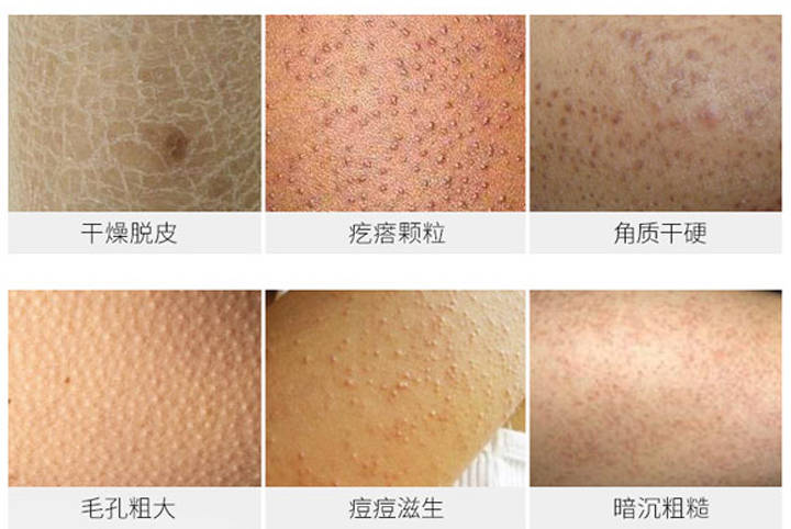 腰两边的皮肤起鸡皮肤(腰部有一块皮肤像鸡皮很粗糙)