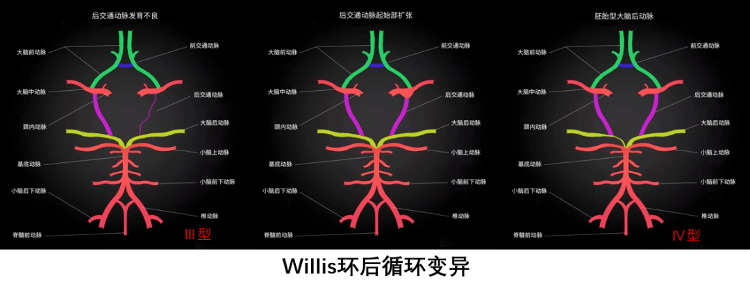 willis动脉环组成图片