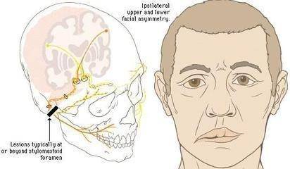 這種疾病主要指的就是一側的面神經受激之後所引發的功能性紊亂,此病
