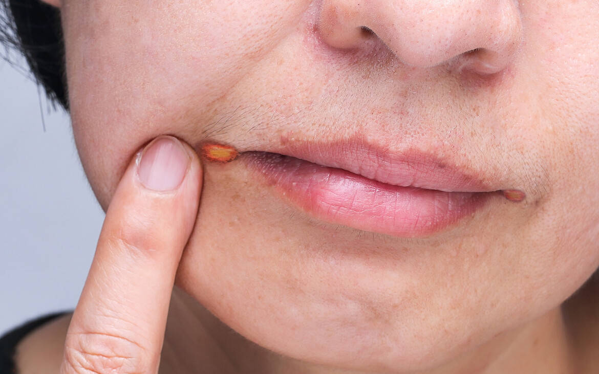 口角发炎是什么原因?应该怎么办?