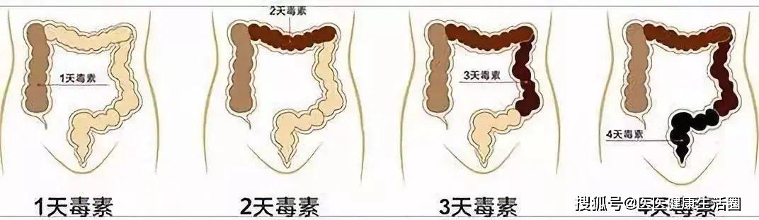 便秘难言之隐对健康危害更大别到得癌才知道