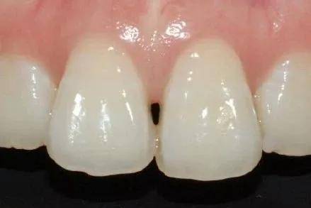 你的牙缝里有没有黑三角快去对号入座