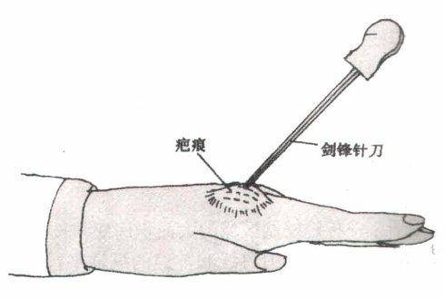 拇指腱鞘炎针刀示意图图片