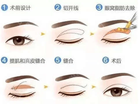 双眼皮|顾客要整成明星？参考这个照着做就行了