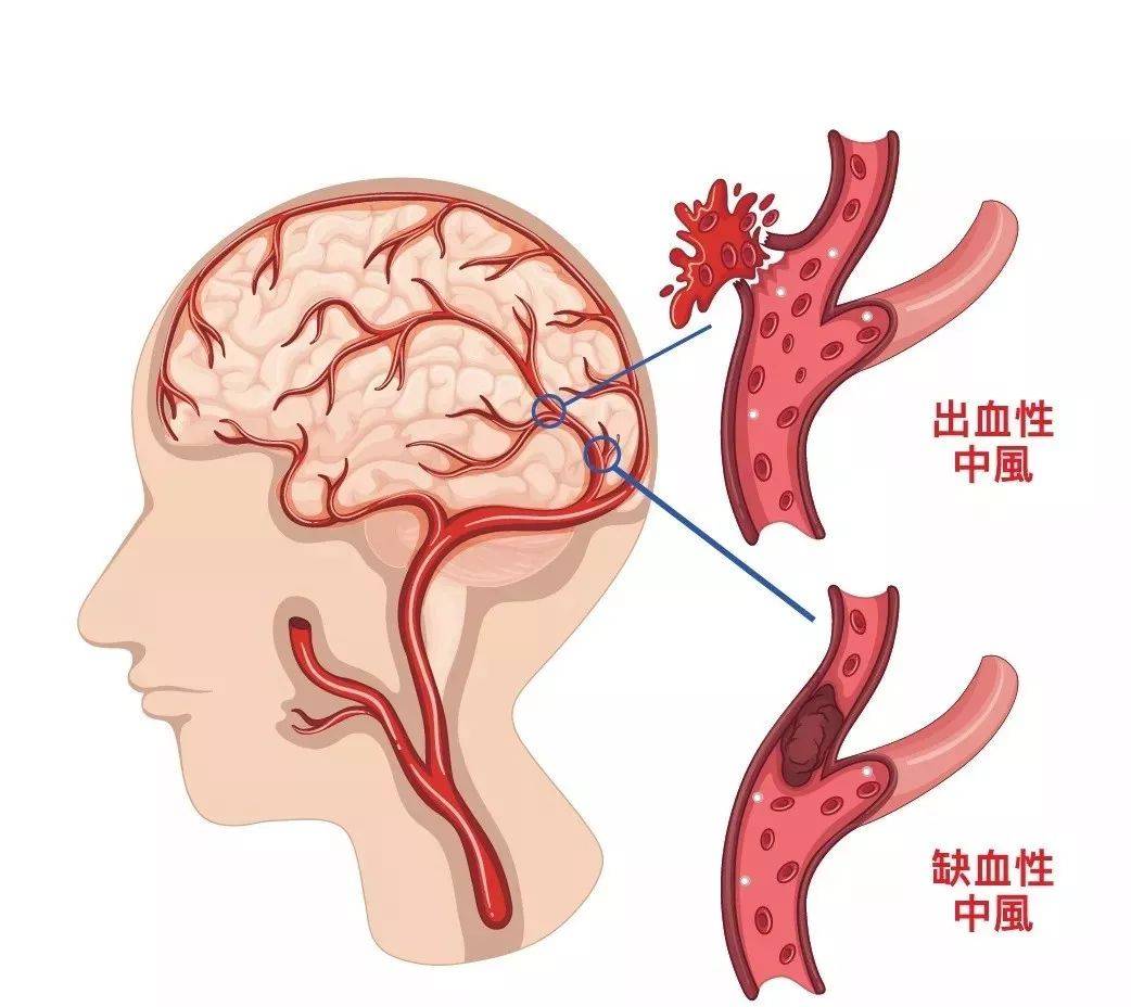 58岁男子,就医时突然昏迷,脑出血离世,这3个行为尽早改