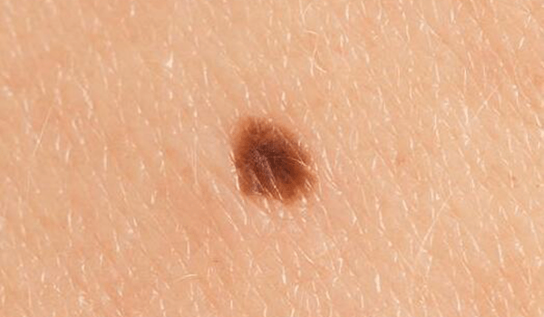 身上出现这几种斑点, 当心这是癌症的征兆!