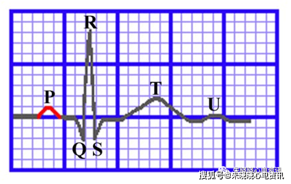 心電圖怎麼看