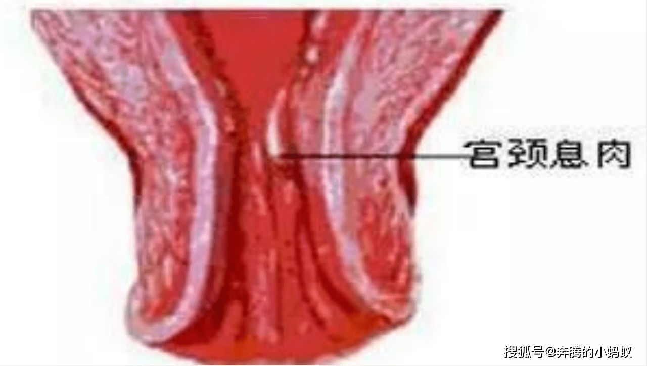 阴部长息肉的图片图片