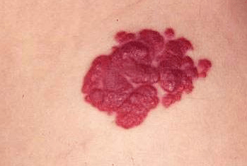 天使之吻血管瘤图片