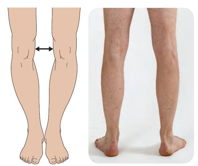 很多人都有"o型腿",只是你没发现,快来自检一下!