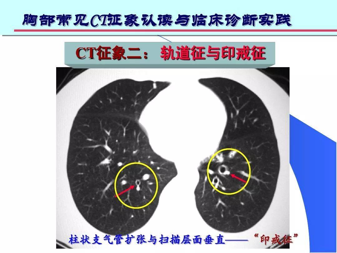 体检后拿到肺部ct却不会看用ct实图教你辨别10大常见征象一