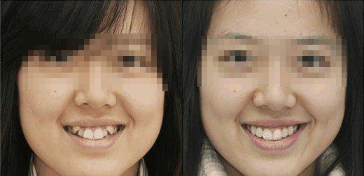 它是帅哥美女的标志,为何不少明星却要拔了它?_虎牙
