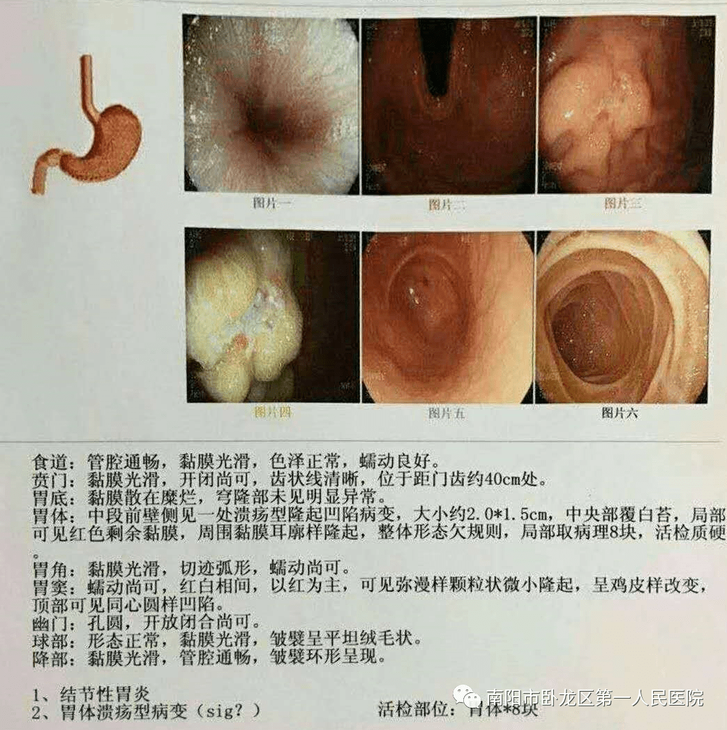【胃肠镜检查的必要性】体检正常,怎么又查出胃癌?