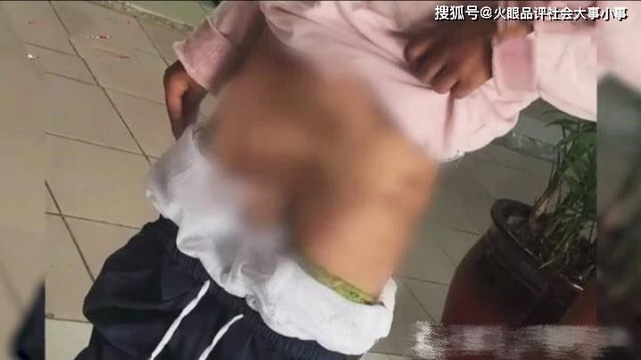 安徽合肥10岁女孩被生母长期虐待伤痕累累