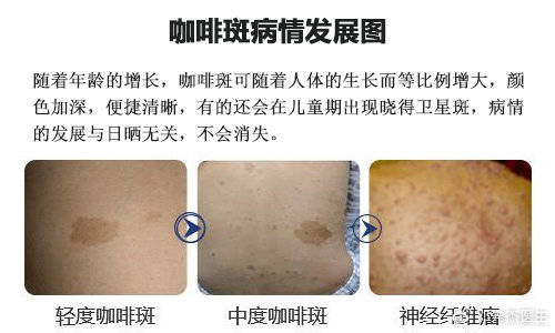 咖啡斑出现这些情况要当心, 请尽快去医院检查诊治!