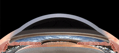 十年前做近视手术的人,现在反弹了吗?