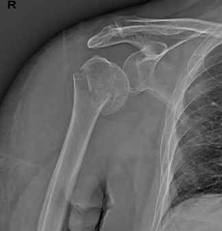 胡医生|【杭州城东医院丨案例】“新技术”为“肱骨近端粉碎骨折”患者复原