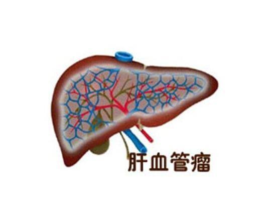 肝血管瘤症状图片
