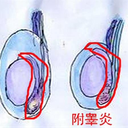 患了附睾炎应该怎么治疗?