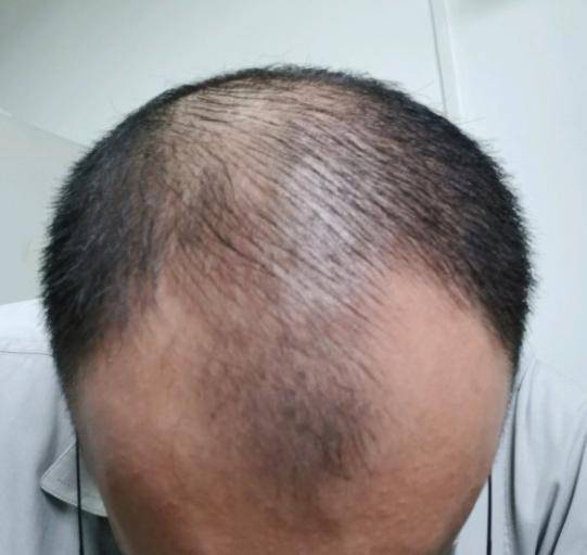 27岁男子家族遗传性脱发头顶和发际线都严重脱发还有救吗