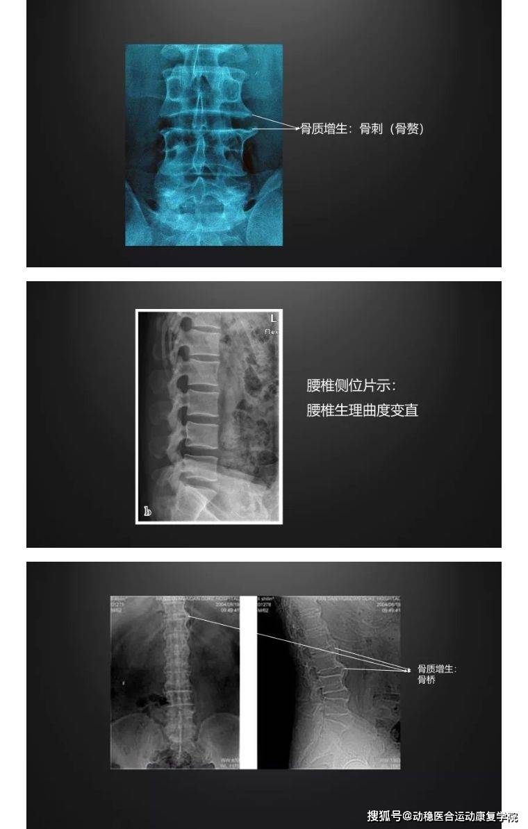 1 腰椎生理曲度变化,正位片有侧弯,侧位片出现曲度变直