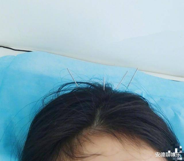 34岁杨幂晒针灸照,一头银针画面吓人,女明星中医治疗方法多_手机搜狐