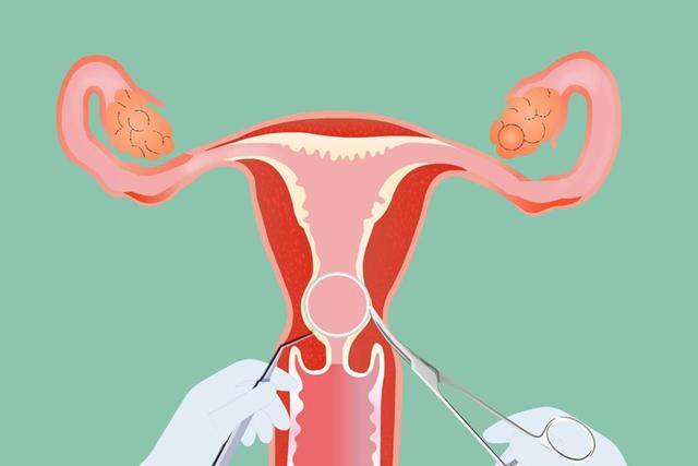 35岁宝妈上环十年整到医院取下环的一瞬间医生在心疼她