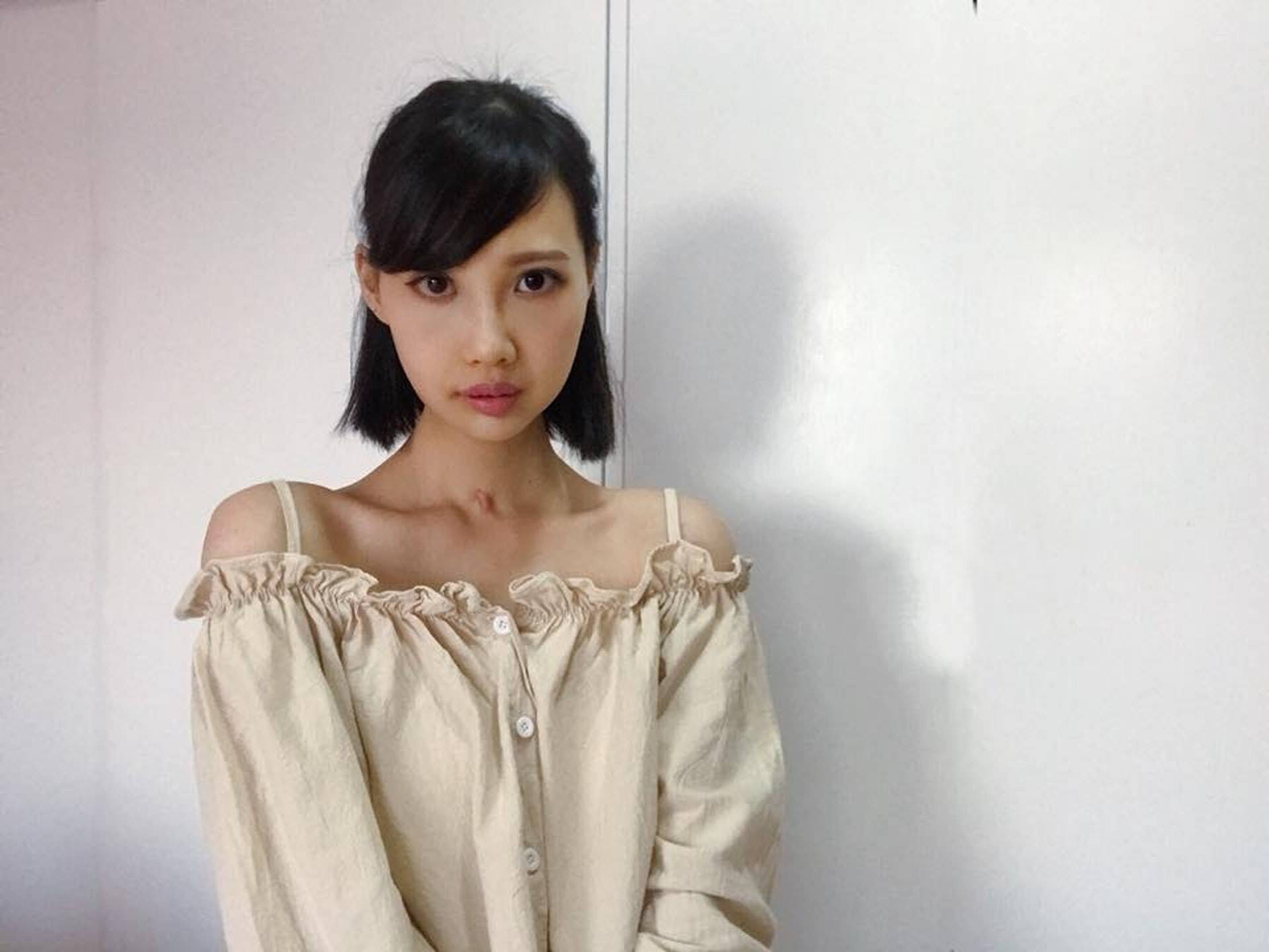 原创恭喜患癌8年的李明蔚完成初步治疗自觉好转比之前呼吸顺畅