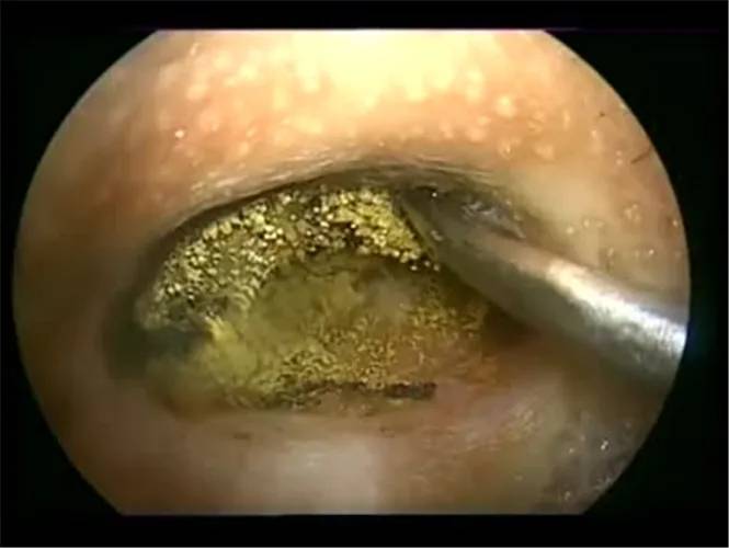 玉山惠耳助听器(分享)外耳道真菌病_耳屎