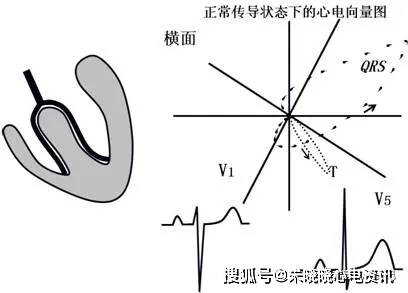 束支阻滯心電圖解析