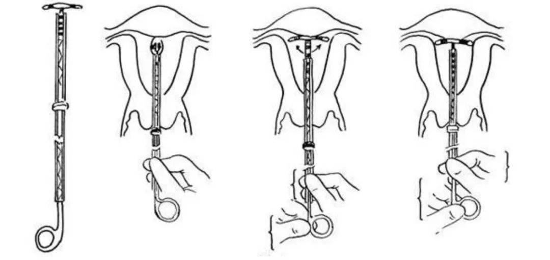 节育环原理图片