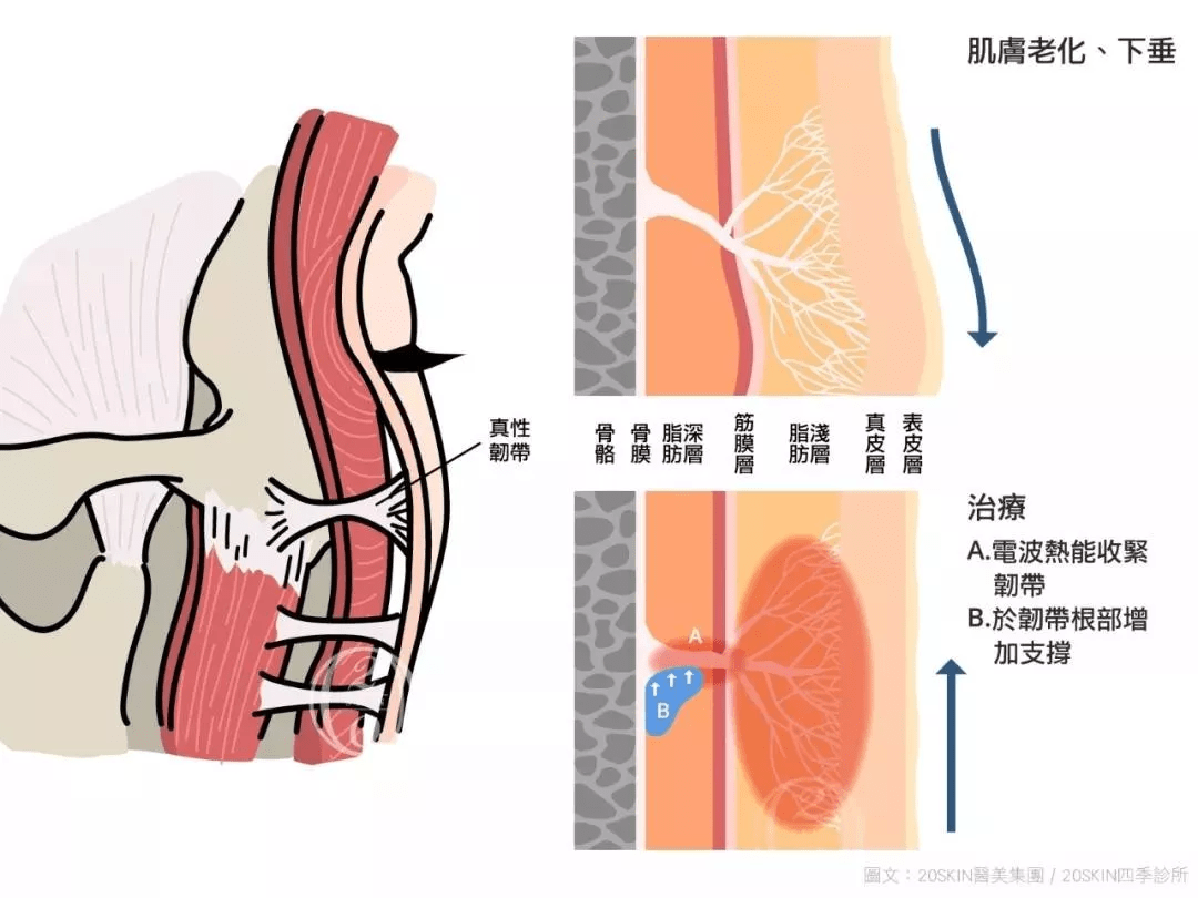 热玛吉做完老得更快？热玛吉一次多少钱