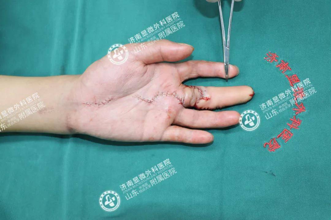 缺失中指,完美重生!我院又成功实施一例3d全形手指再造