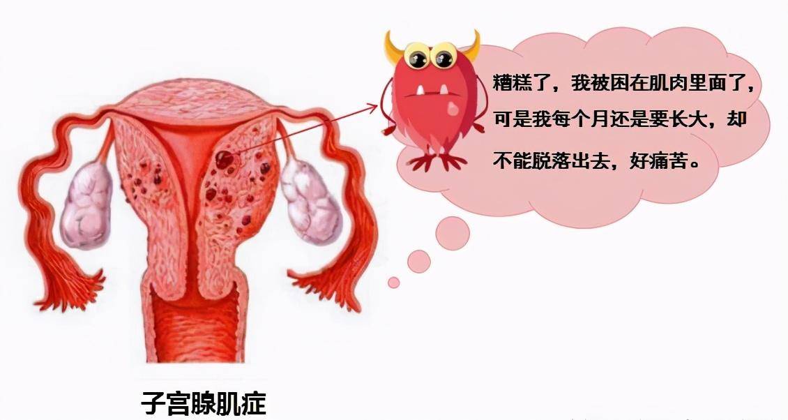 子宫腺肌症弥漫性局限性怎么区分