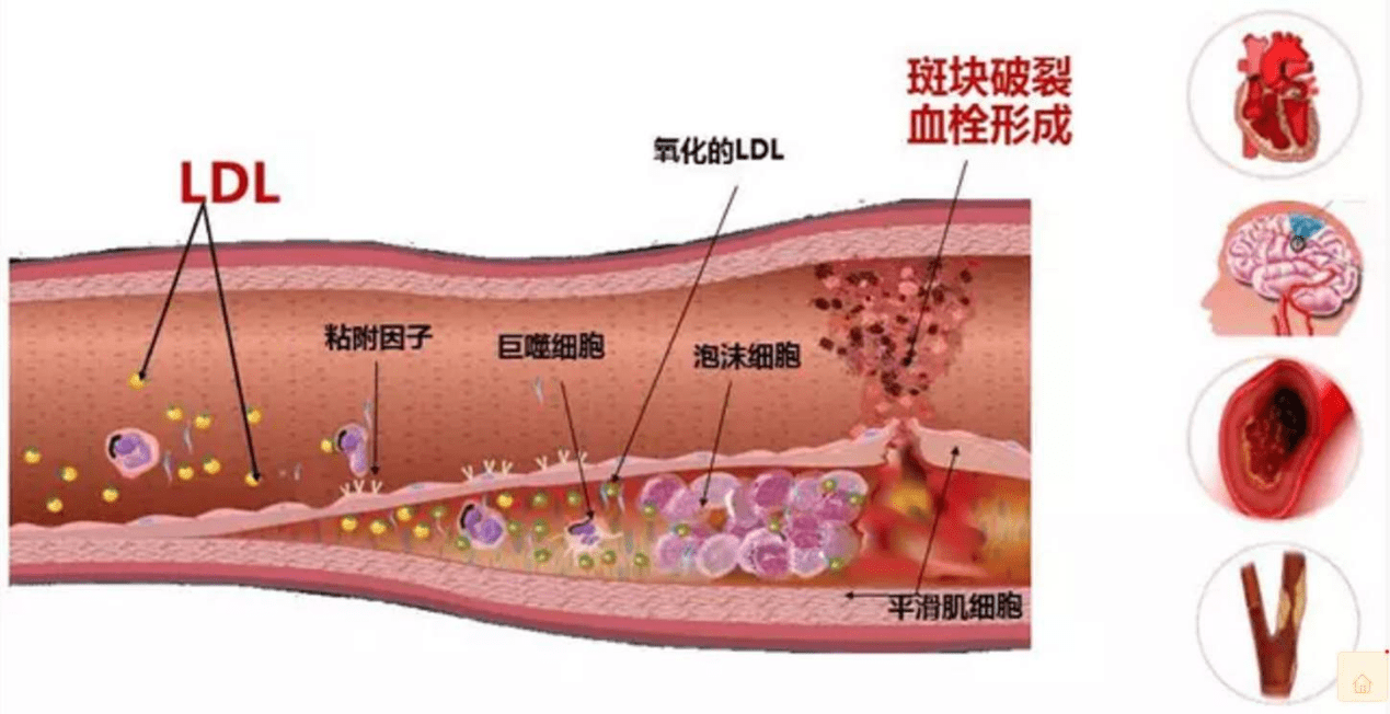 引言:總膽固醇高是很多人都可能會面臨的一個問題,也是比較廣泛的血管