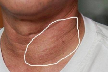 首大张洋:男性查出甲状腺结节要更加重视