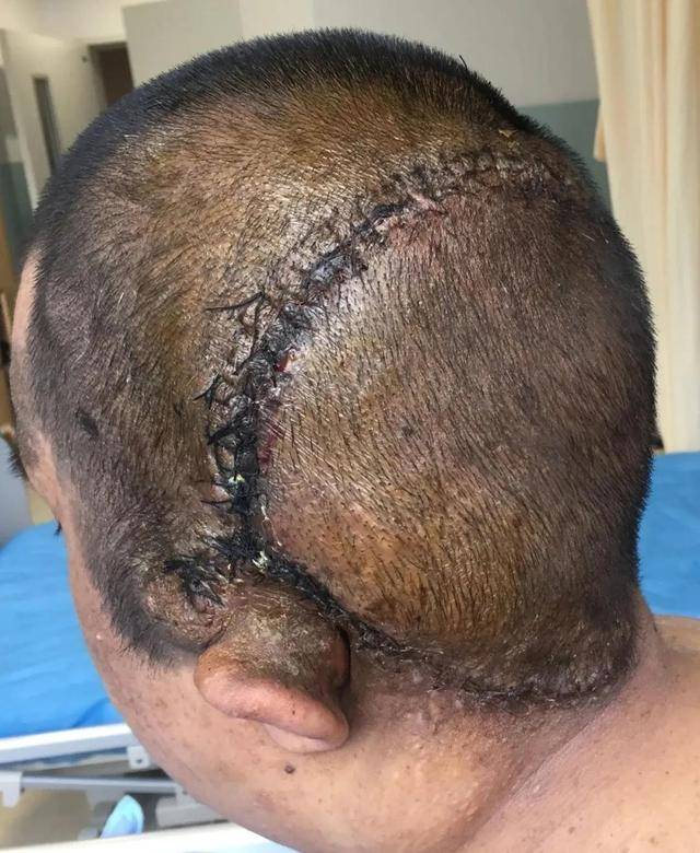 术后第二天头颅ct复查未见脑积水形成,无异常出血.