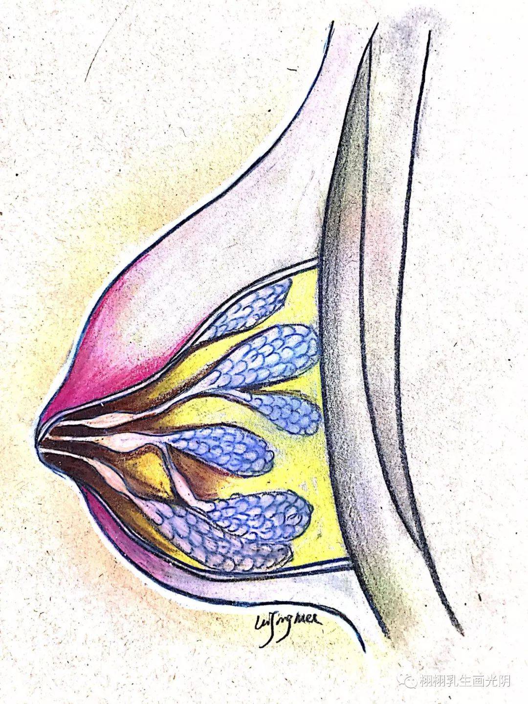 乳腺瘘管照片症状图片