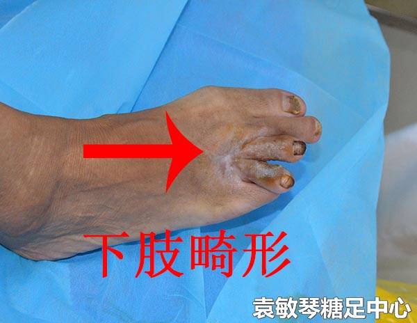 糖尿病脚变形的原因是什么严重吗
