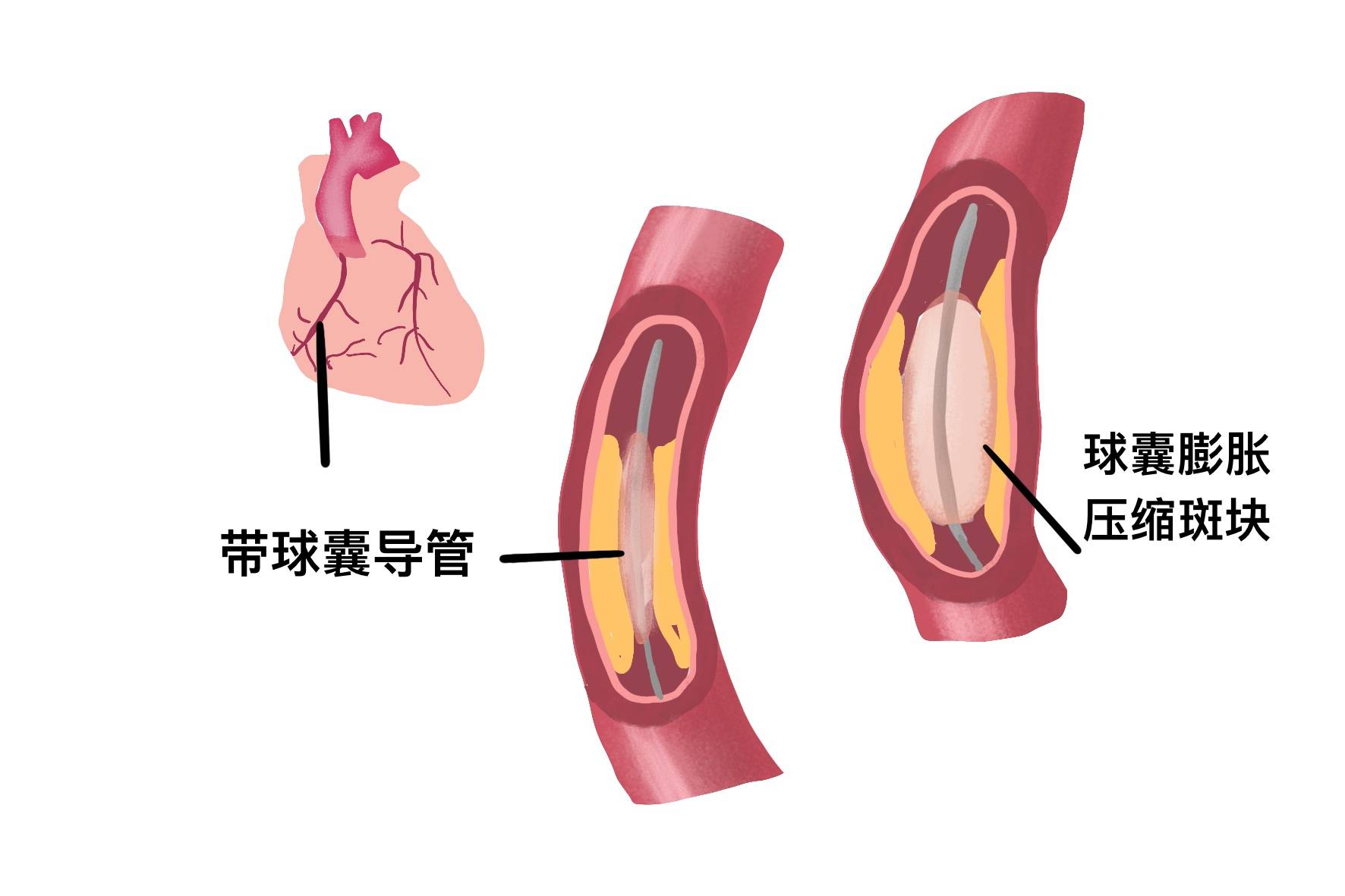 心脏球囊和支架的区别图片