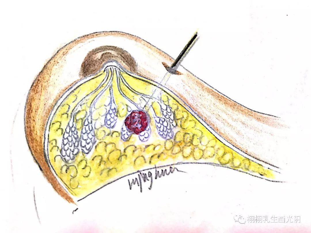 乳房结节需要穿刺吗