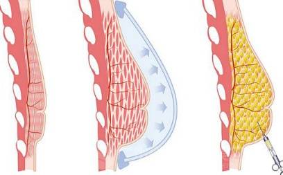 自体脂肪丰胸后为何会出现硬块