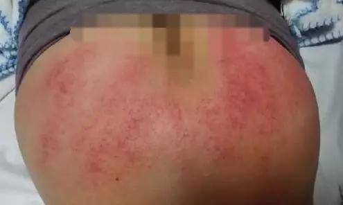 刮痧后的痧印分析99的人都弄不清