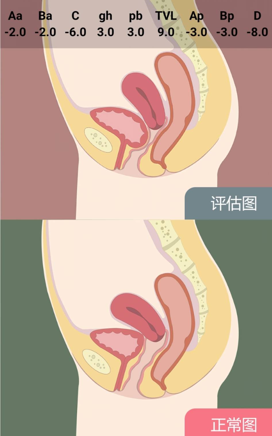 一到四度裂伤示意图图片