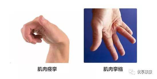 误区|| 挛缩:是指关节本身,肌肉和软组织病变引起关节的被动活动范围