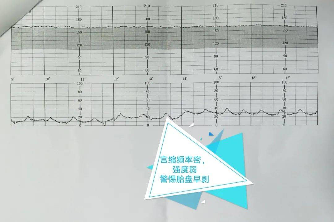 医护及时发现"藏起来"的胎盘早剥~紧急!绿色通道护航"大小平安"