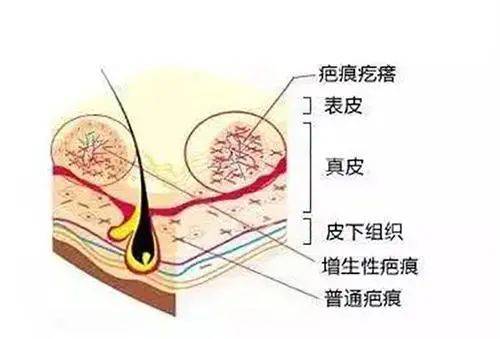 外阴瘢痕疙瘩图片