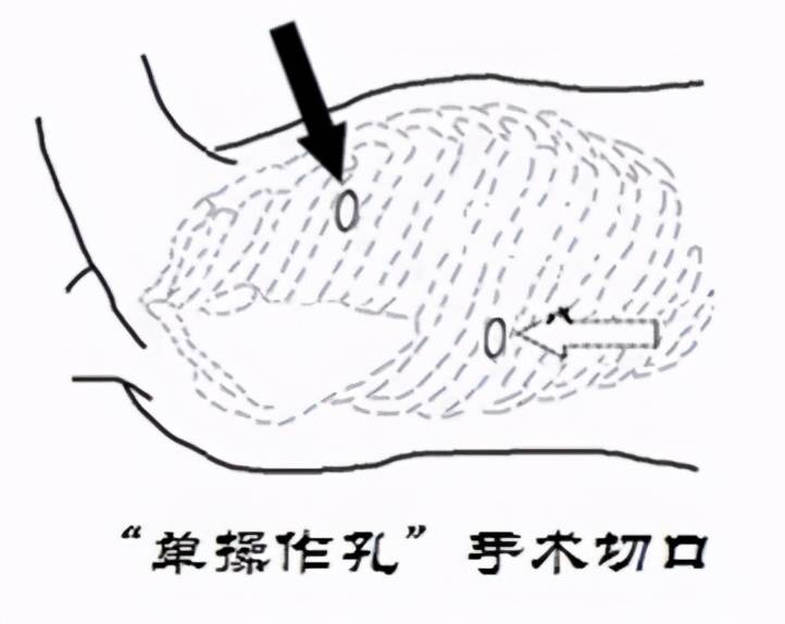 外剥内扎术 来自搜狐网