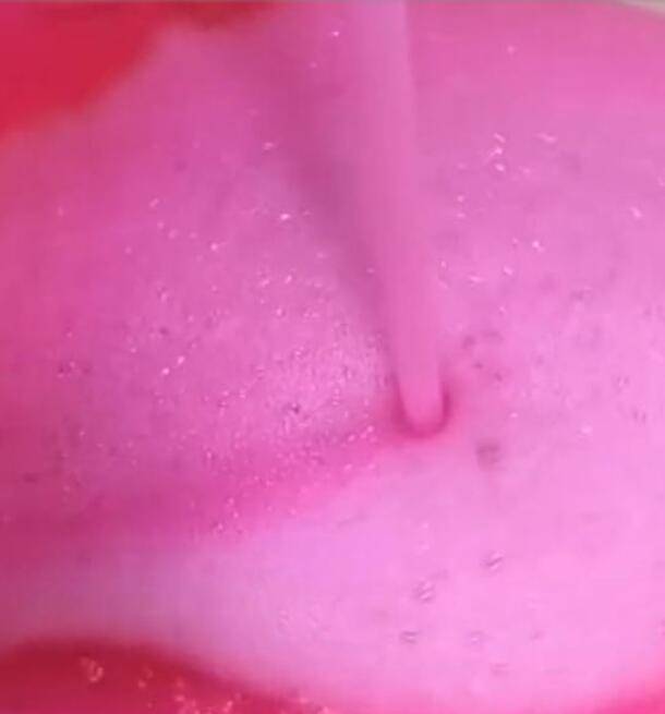 粉红色泡沫痰图片