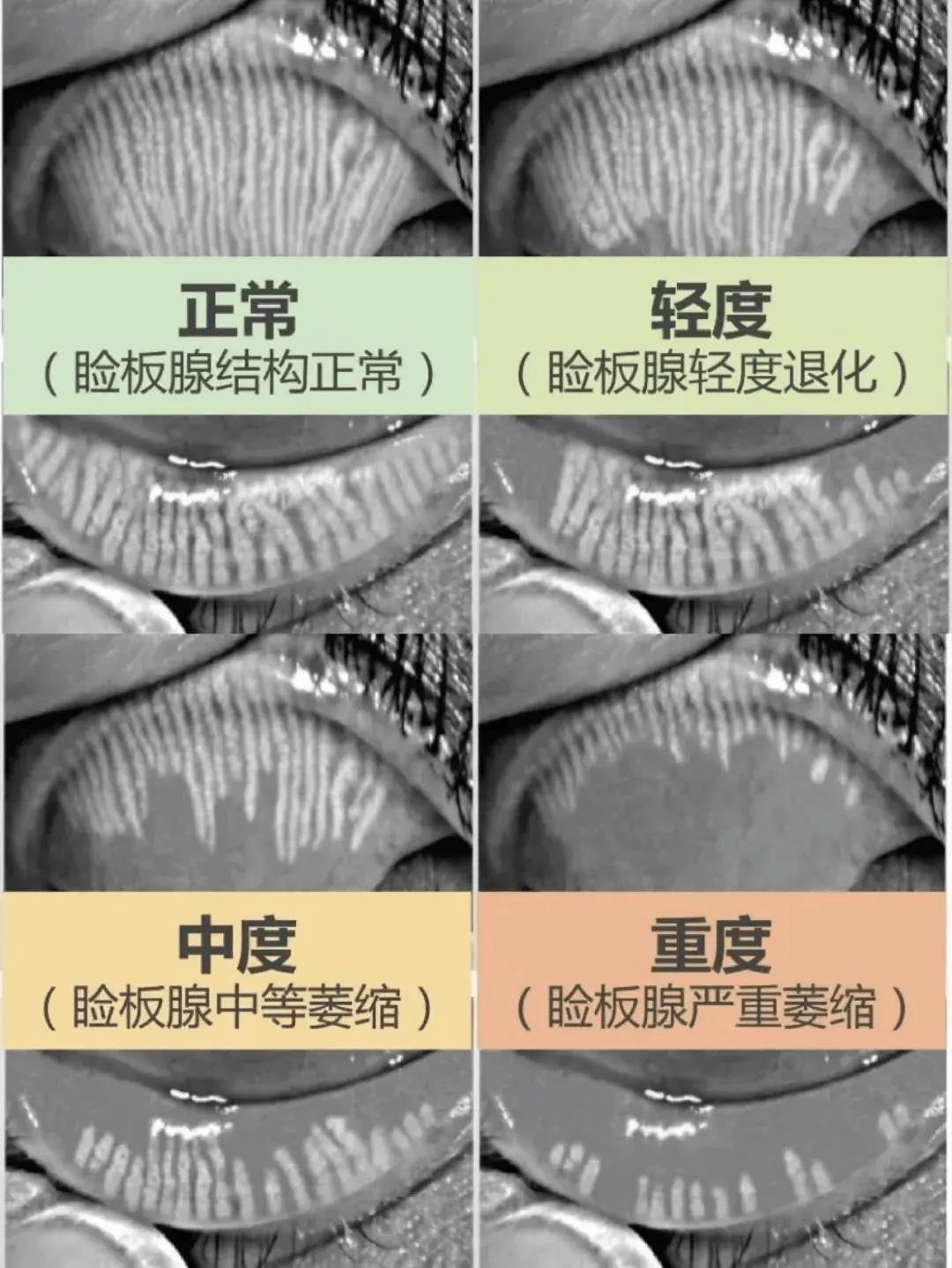 12岁女孩患干眼症！睑板腺萎缩影响不可逆！_刘瑶